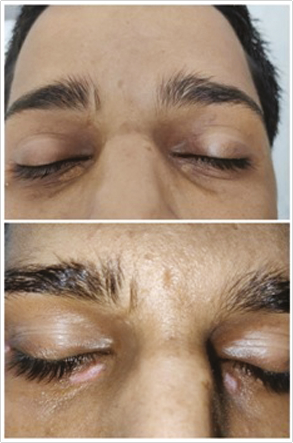 Pre and posttreatment images of a patient with grade 2 lesion showing scarring after treatment with Erbium yag laser