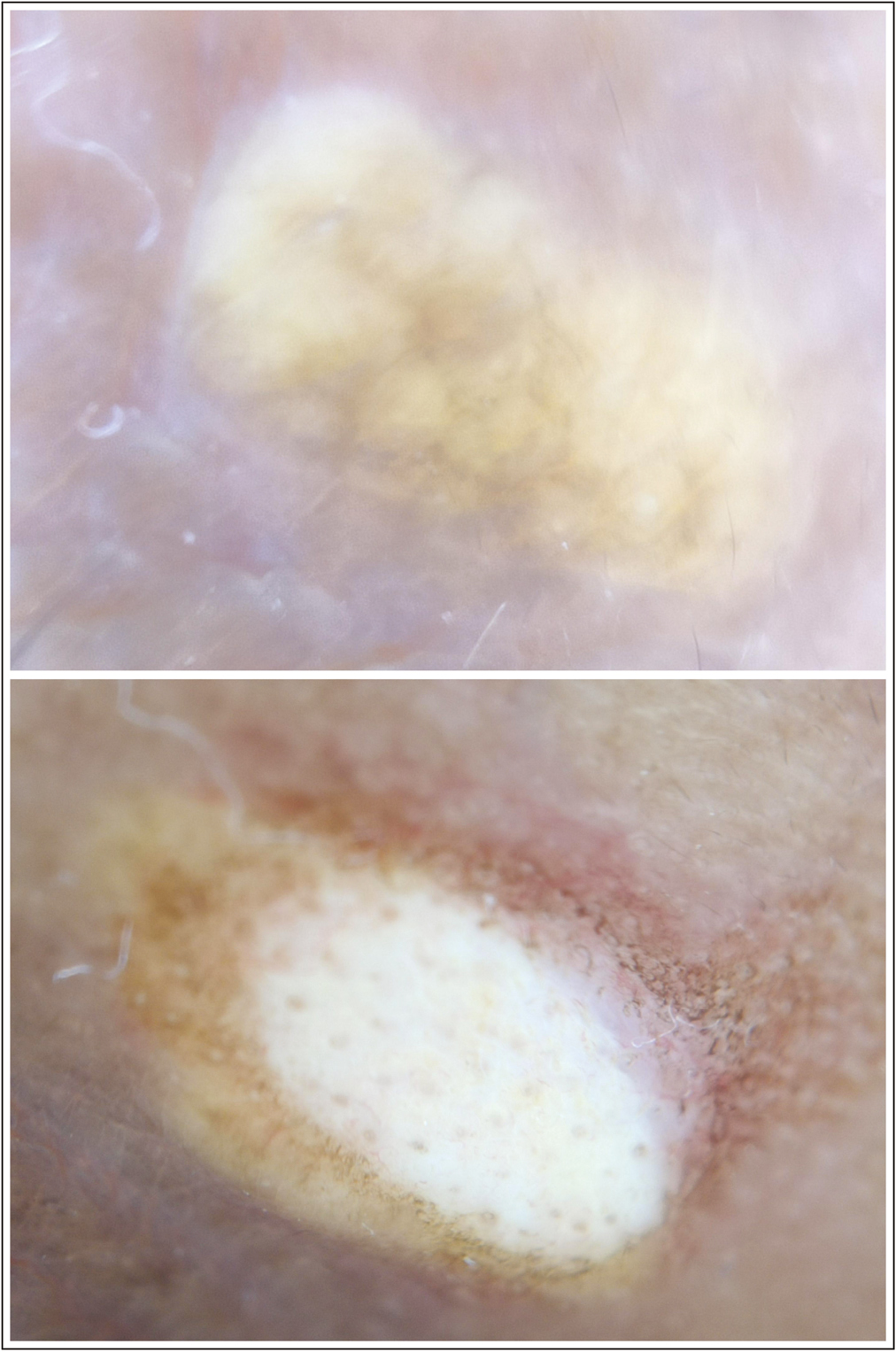 (A) Dermoscopic image of xanthelasma palpebrarum before treatment showing the network of brown streaks on a background of the yellowish structureless area; (B) the dermoscopic image of a lesion at 2 weeks follow-up showing remnants of adipose tissue along the margins