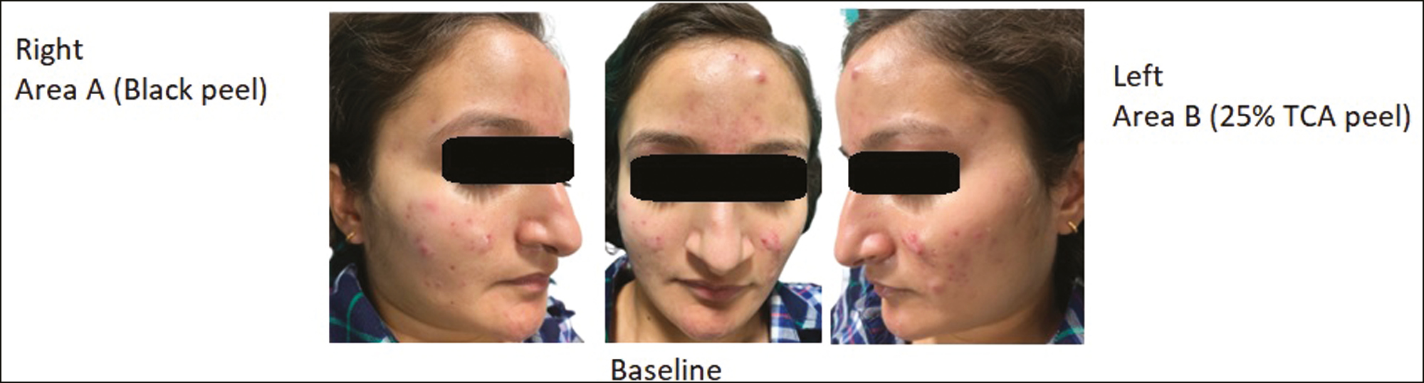 Baseline picture of 20-year-old patient in both the groups