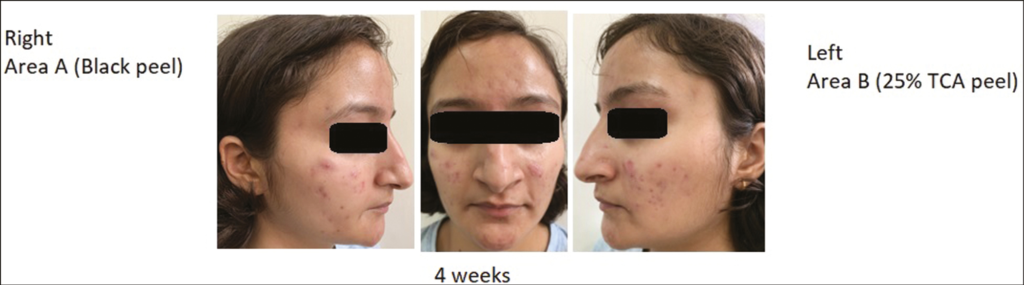 Picture of 20-year-old patient in both the groups at 4 weeks