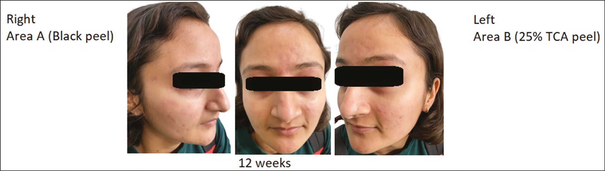 Picture of 20-year-old patient in both the groups at 12 weeks