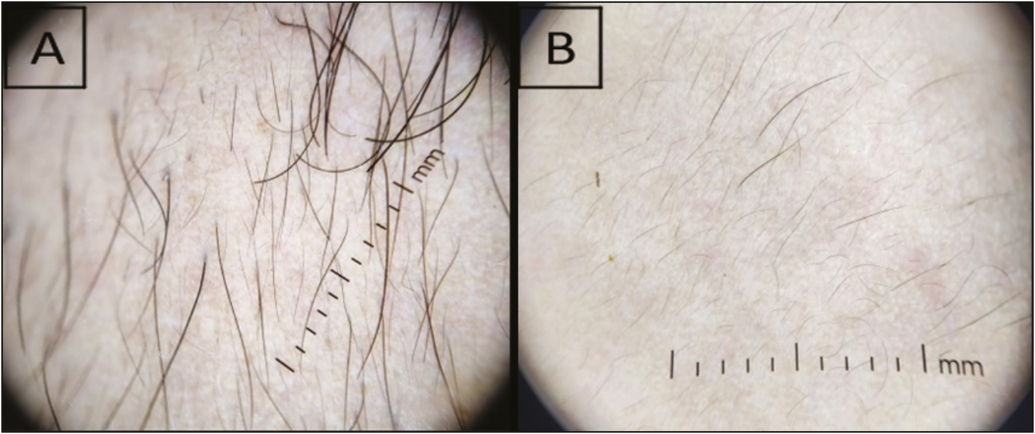 (A) Trichoscopic assessment of facial hair at baseline and (B) after 6 sessions of diode laser