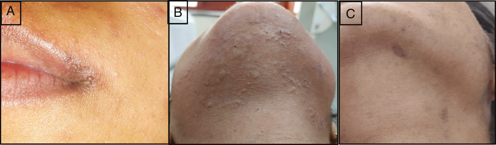 (A) Adverse effects after laser sessions-herpes labialis, (B) perifollicular edema, and (C) hyperpigmentation