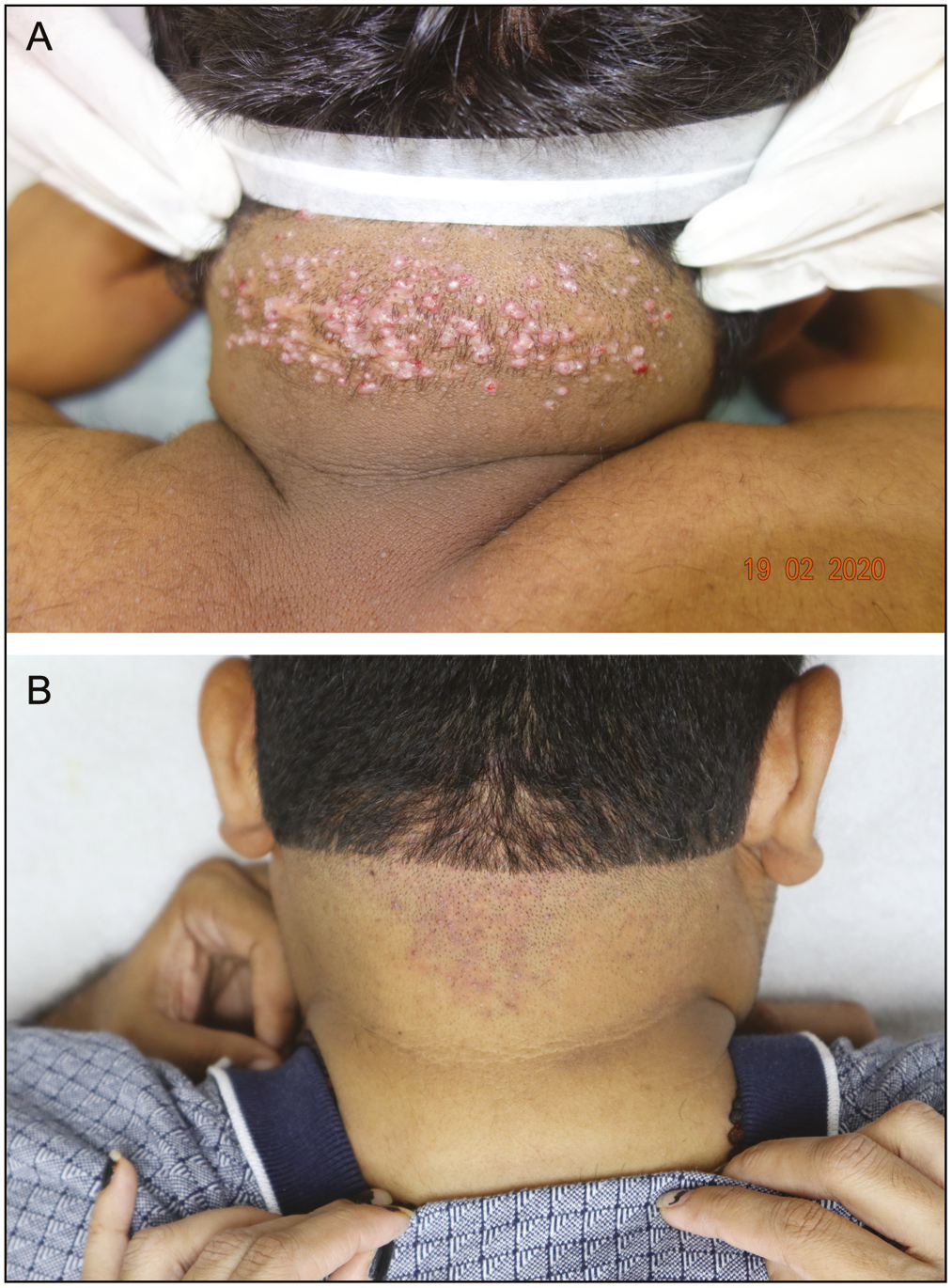 (A) Multiple keloidal nodules over the nape of the neck. (B) Complete resolution of the lesions after 3 sessions and 6 months after end of all treatment sessions