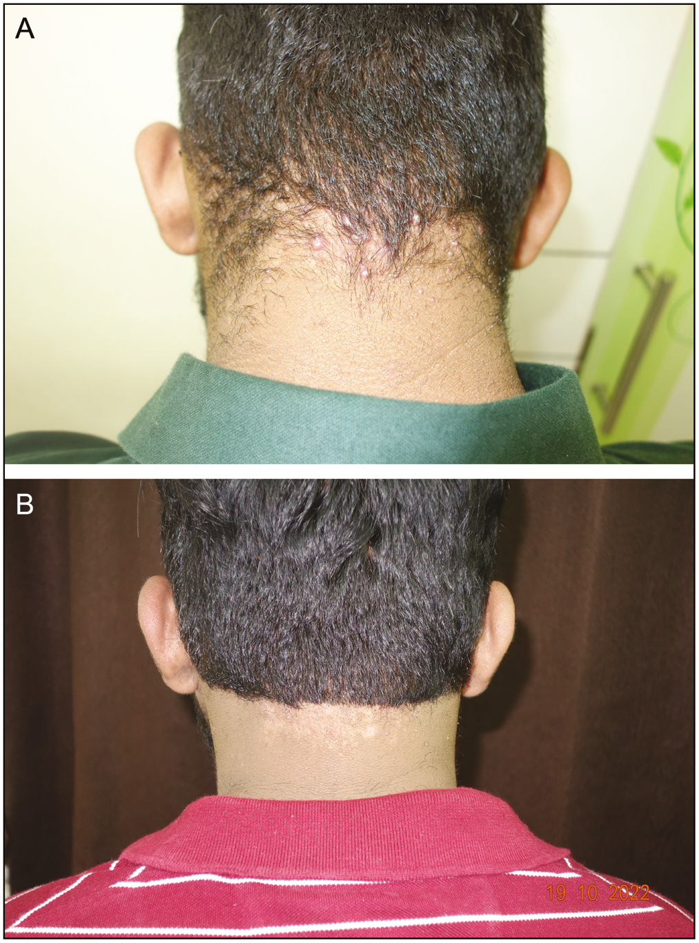 (A) Multiple keloidal nodules over the nape of the neck. (B) Complete resolution of the lesions 6 months after end of all treatment sessions