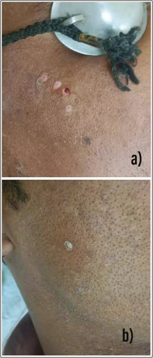 (A) Pinpoint bleeding as clinical end point of erbium YAG laser ablation. (B) Solid frosting as clinical end point of TCA application