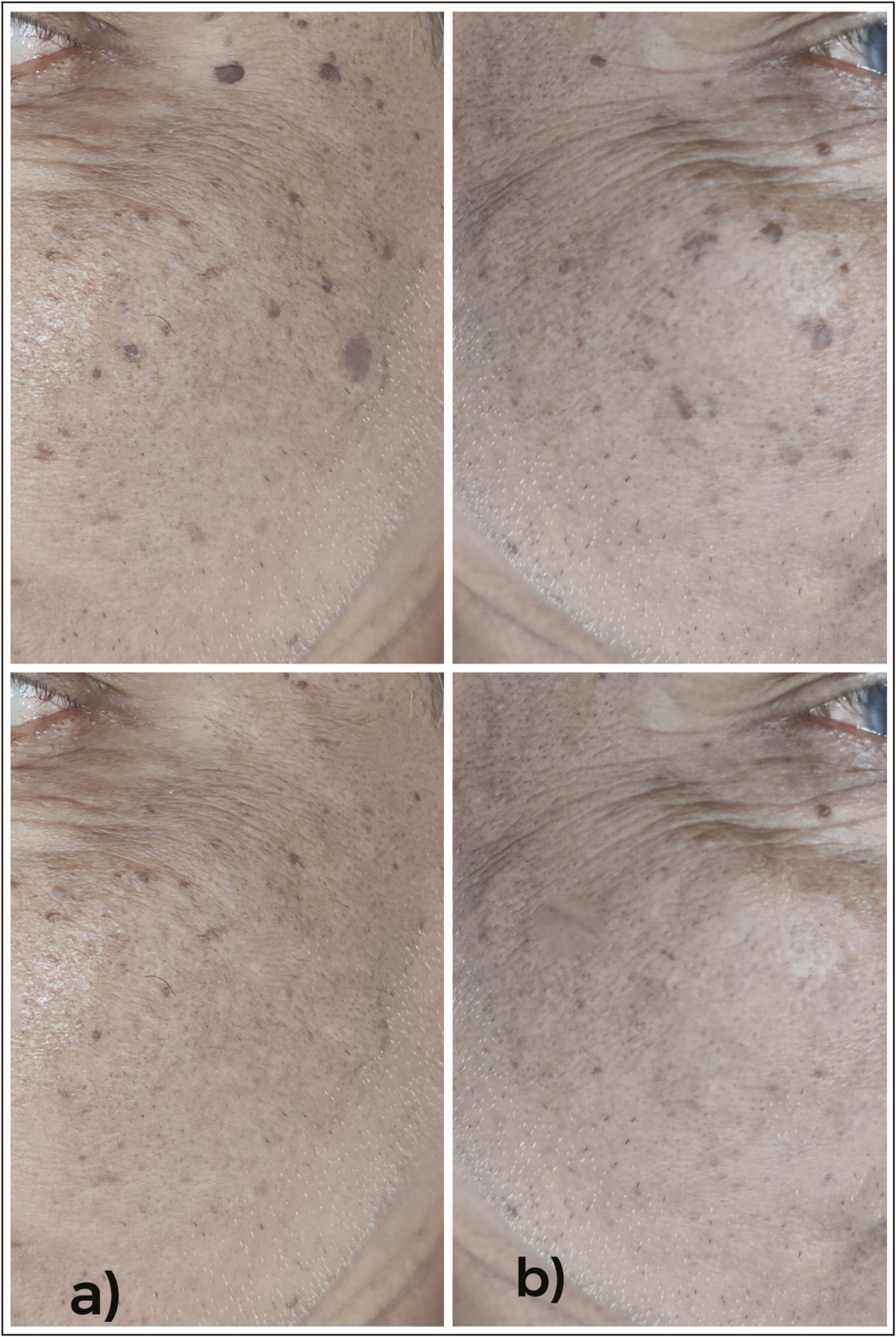 (A) Pre- and posttreatment images of patient with seborrheic keratosis after treatment with Erbium YAG laser showing complete clearance without any adverse effects. (B) Pre- and posttreatment images of patient with seborrheic keratosis after treatment with 70% TCA showing complete clearance without any adverse effects