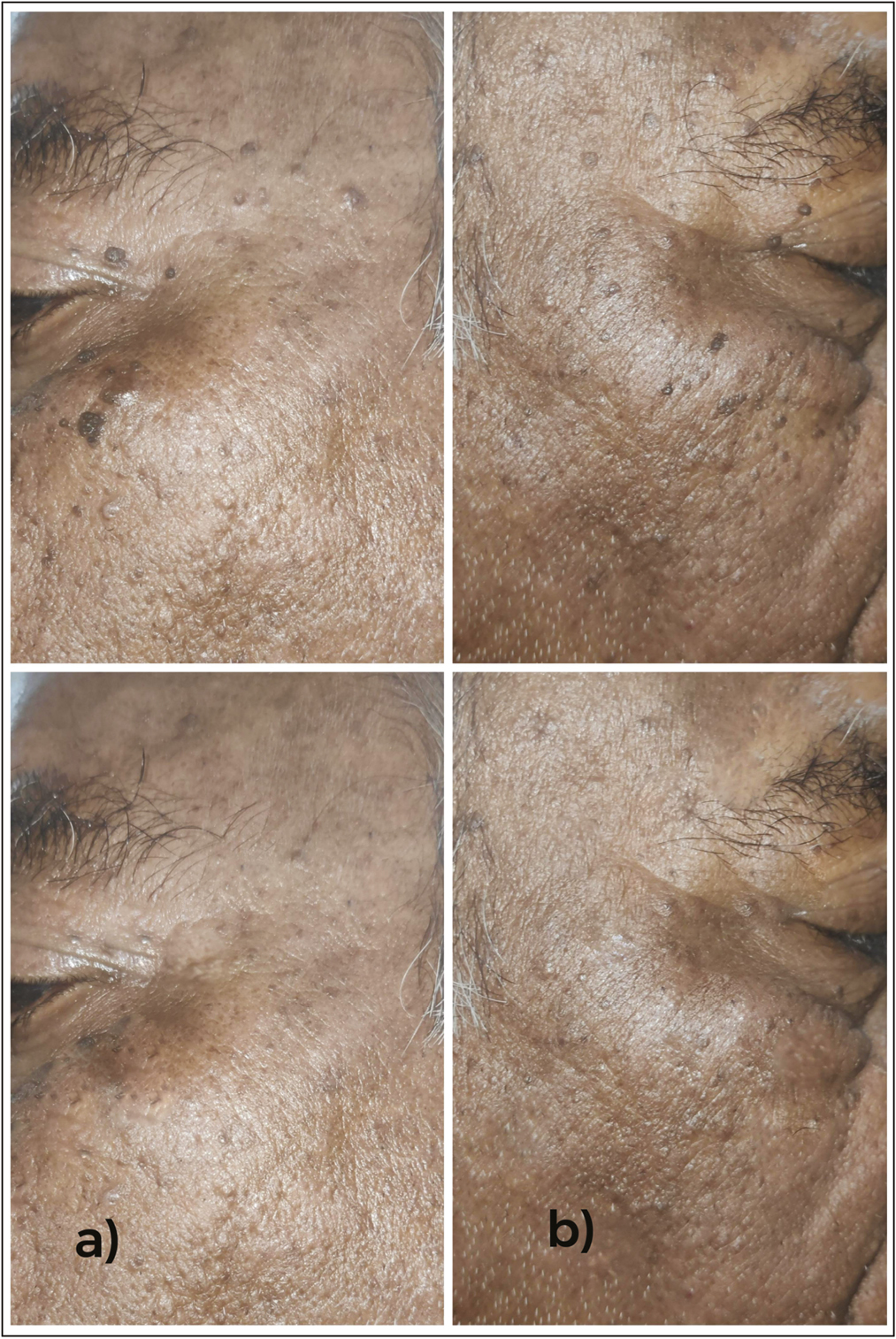 (A) Pre- and posttreatment images of patient with seborrheic keratosis after treatment with Erbium YAG laser showing complete clearance without any adverse effects. (B) Pre- and posttreatment images of patient with seborrheic keratosis after treatment with 70% TCA showing complete clearance without any adverse effects