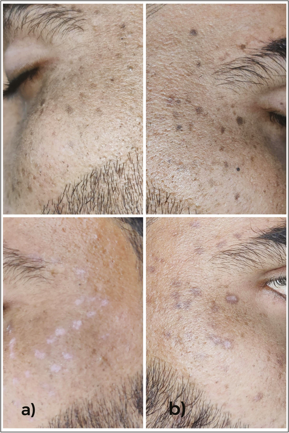 (A) Pre- and post-treatment images of patient with seborrheic keratosis showing scarring after treatment with erbium YAG laser. (B) Pre- and posttreatment images of patient with seborrheic keratosis after treatment with TCA 70% showing partial response and post inflammatory hyperpigmentation