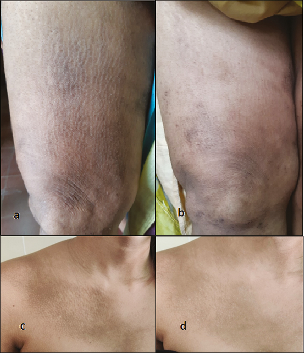 Group C—Q-switched Nd-YAG laser showing good improvement (A and B: baseline VAS 8, after 6 months VAS 3; C and D: baseline VAS 7, after 6 months VAS 3)