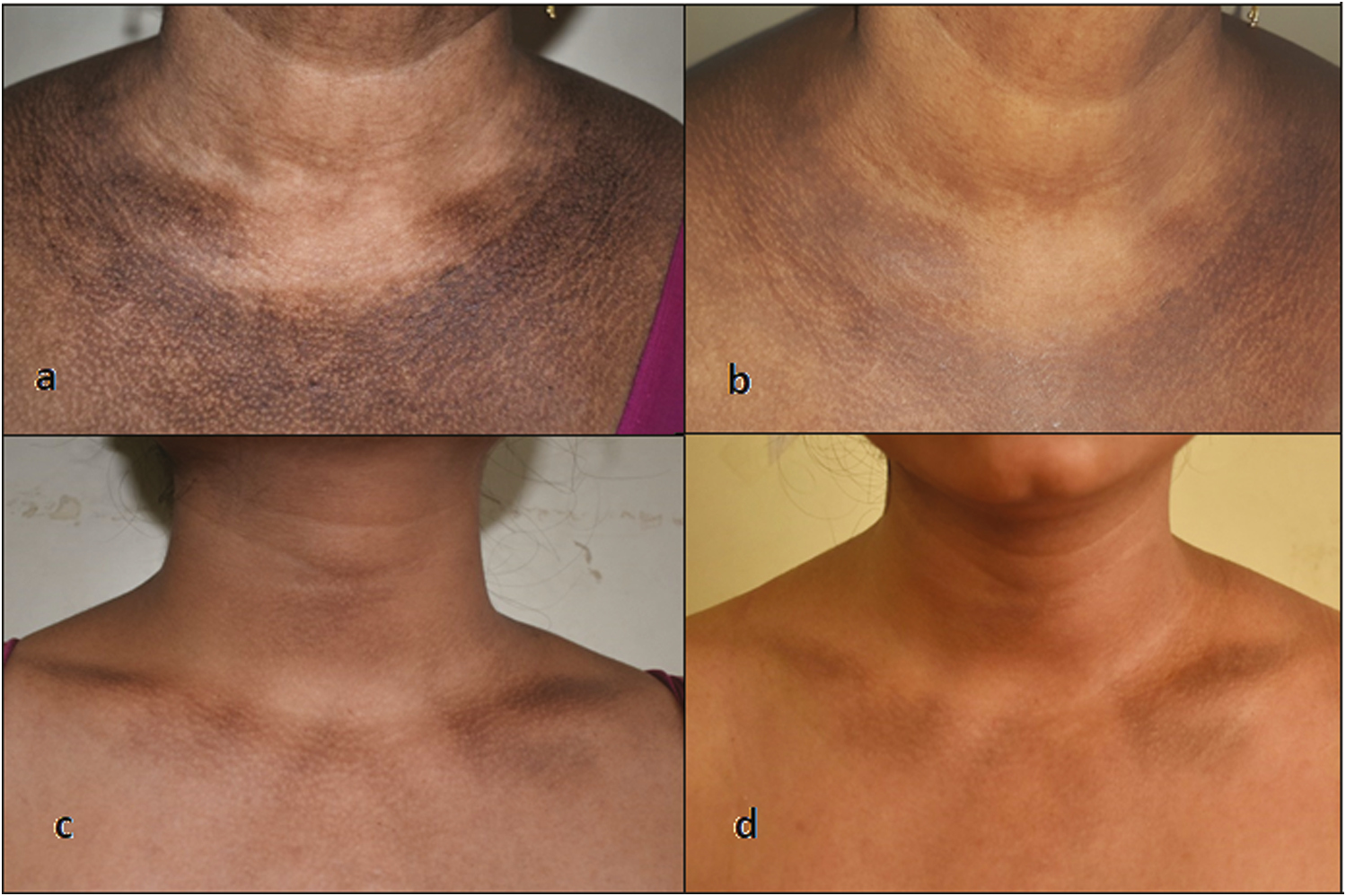 Group B—Glycolic acid peel showing poor improvement (A and B: baseline VAS 10, after 6 months VAS 8; C and D: baseline VAS 8, after 6 months VAS 7)