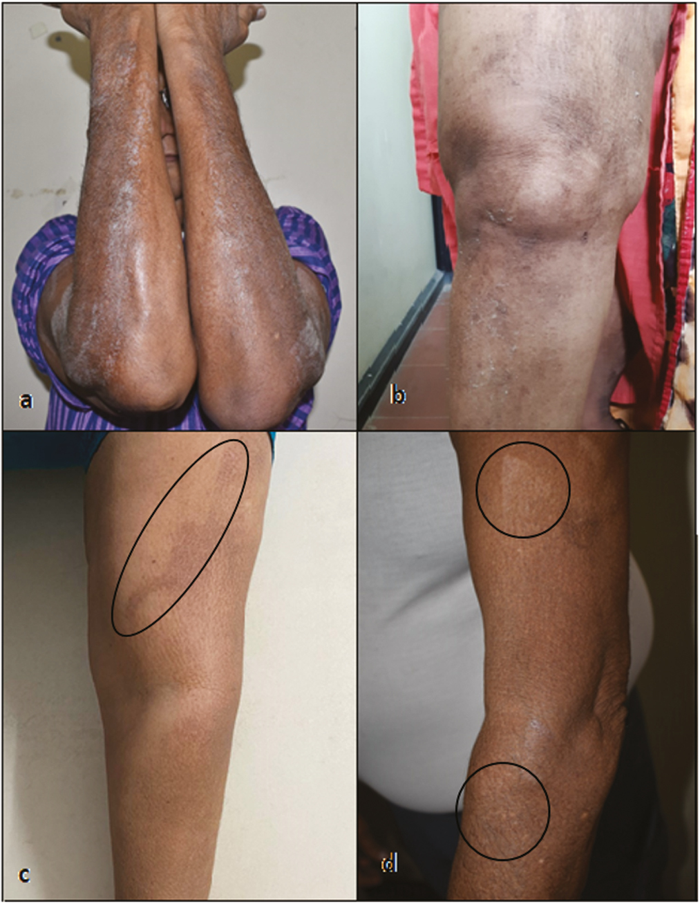 Adverse events in Group A: (A) immediate frosting after TCA peel, (B) post-TCA peel desquamation, (C) postinflammatory hyperpigmentation after TCA peel, (D) postinflammatory hypopigmentation after TCA peel