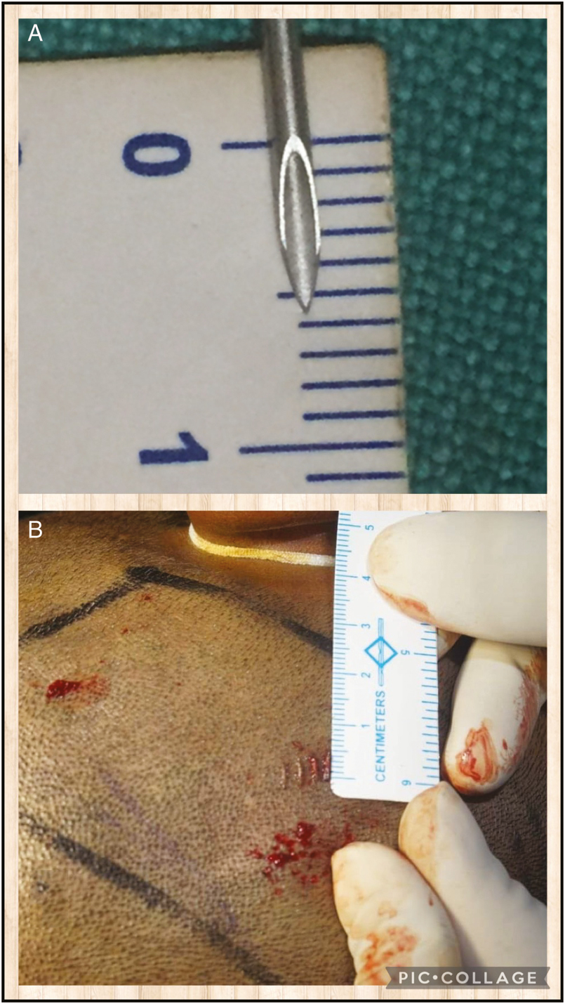 (A and B) Mismatch in the length of bevel portion (5.5 mm) of 18-G needle and of hair follicle (4 mm)