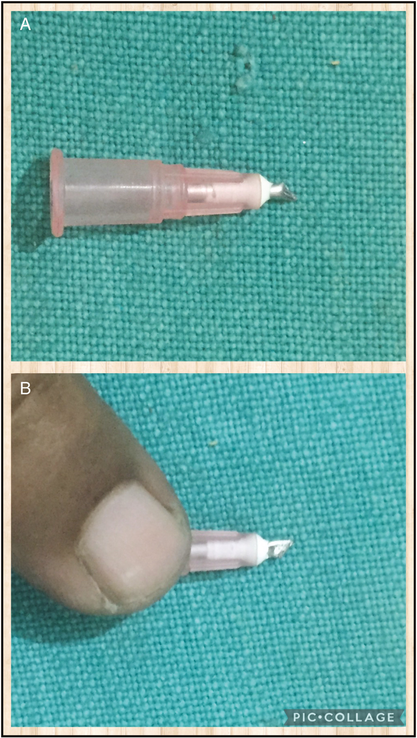 (A and B) Modified needle (18 G) with its hub for guarded comedone prick