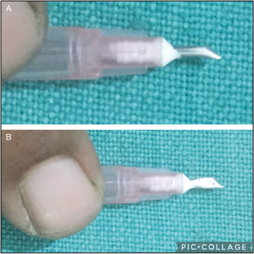 (A and B) Modified needle 18 G with its hub (1.5 mm) for guarded slit incision on scalp