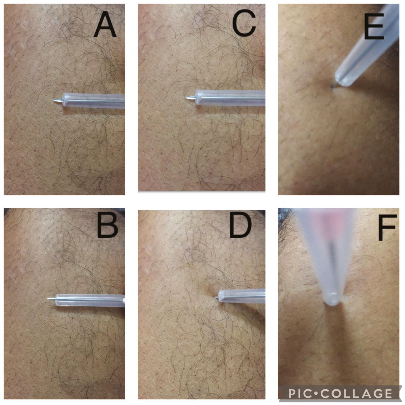 (A-F) 18-G needle is guarded with modified needle cap (4 mm) for horizontal, and angulated and vertical slit incision over scalp for hair transplantation