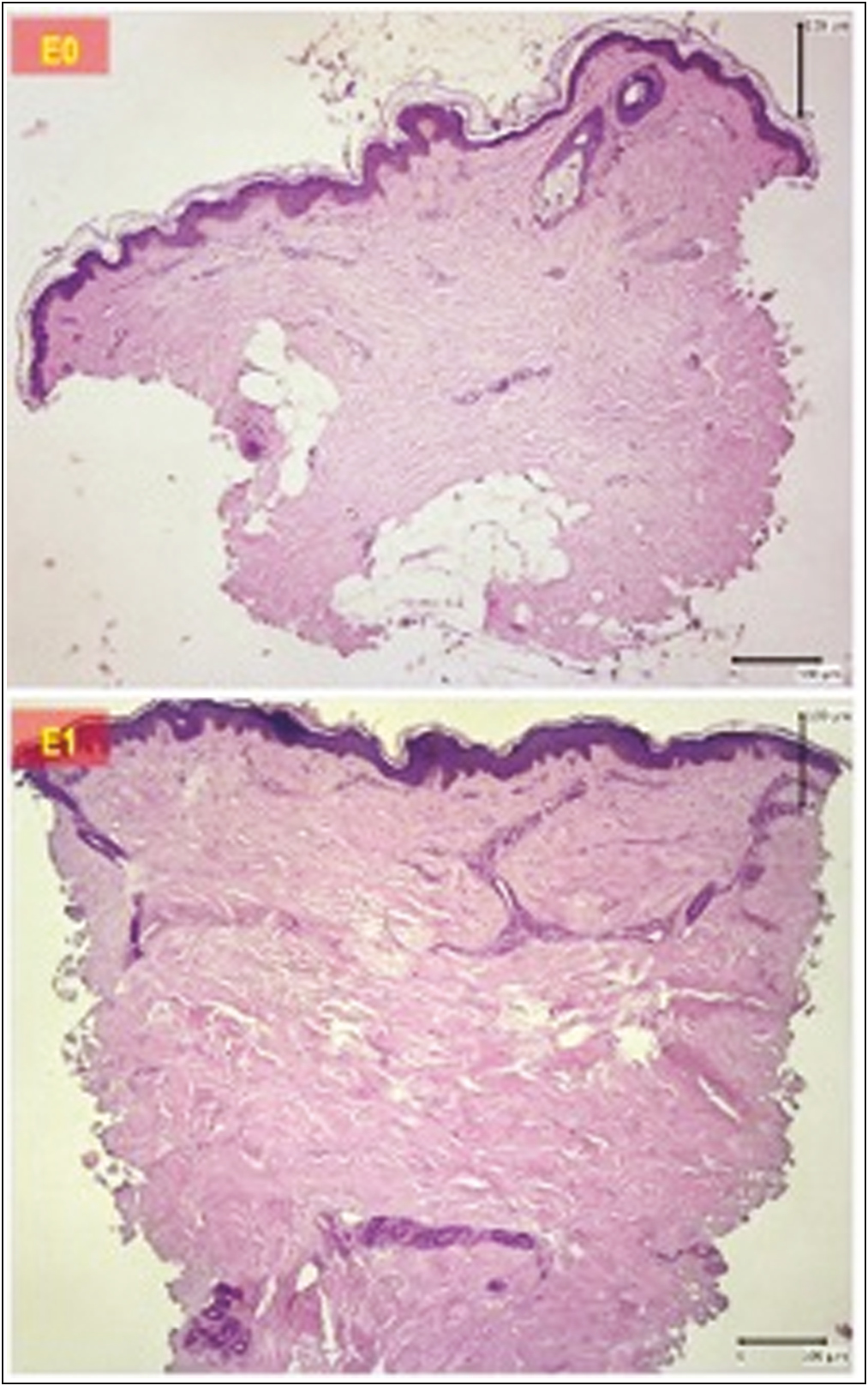 Comparison of dermal thickness before and after therapy. Upper: before therapy. Lower: after therapy