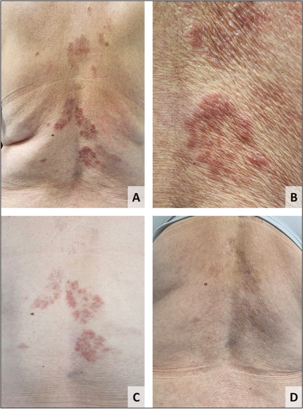 Granuloma annulare, clinical images: (A) erythematous-violaceous plaques arranged in an annular configuration on the back; (B) clinical photography after the first PDL session; (C) complete resolution of granuloma annulare after 2 PDL sessions