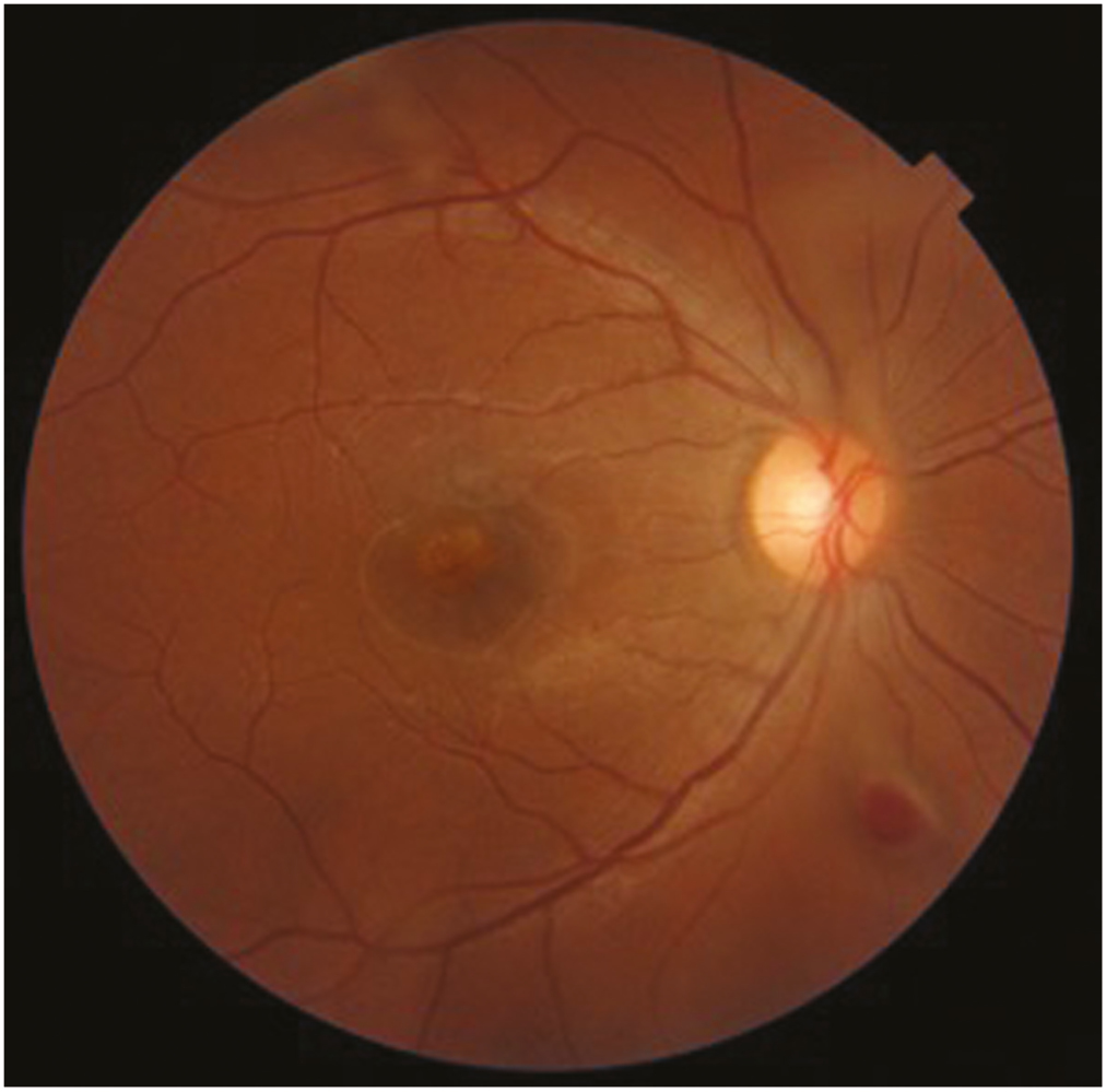 Fundus photo of the right eye reveals full thickness macular hole and resolving vitreous hemorrhage