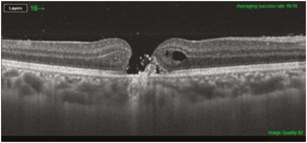 Spectral domain optical coherence tomography (SD-OCT) shows a full thickness macular hole with IS-OS junction disruption and hyperreflective mass in base with cystic spaces at the edges of the hole in right eye