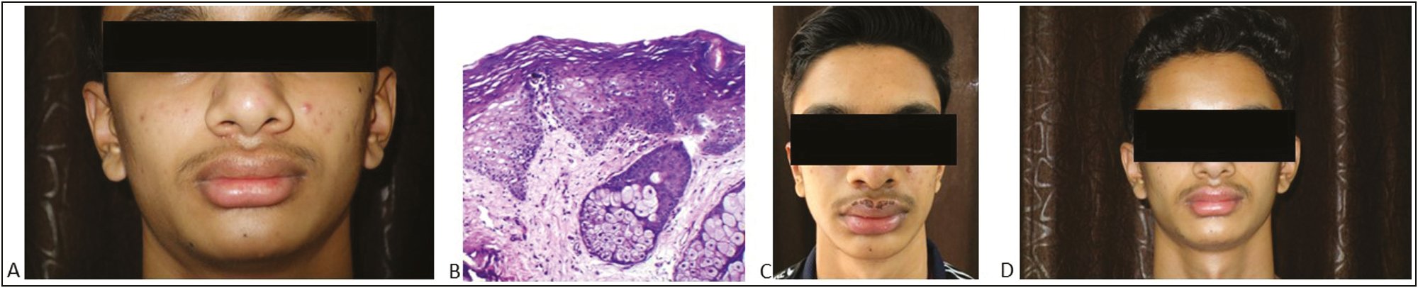 (A) Multiple, well-defined, yellowish papules over the upper lip, (B) (H&E, 40× magnification) it shows mild spongiosis attached to the epithelium, and opening onto the surface is a well-developed lobulated sebaceous gland. The submucosa shows a moderately dense lymphoplasmacytic infiltrate. (C) (Postprocedure after 2 weeks): crusting present over the upper lip, (D) resolution of lesions postprocedure after 16 weeks of treatment