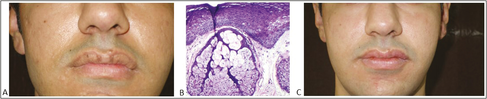 (A) Multiple, well-defined whitish to yellowish papules coalescing to form plaques on the upper lip, (B) (H&E, 40× magnification) it shows mild spongiosis and well-developed lobulated sebaceous gland suggestive of Fordyce spots, (C) resolution of lesions postprocedure after 16 weeks of treatment