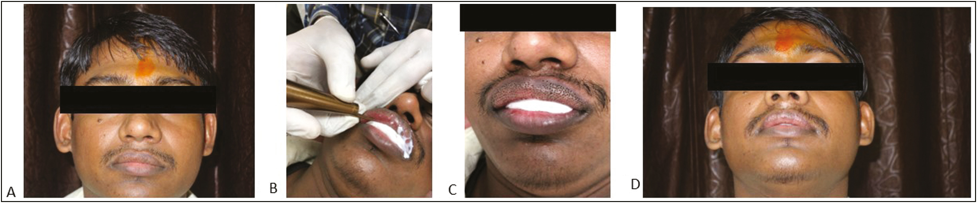 (A) Multiple, discrete, yellowish papules over the upper lip, (B) Pinhole ablation technique using CO2 laser, (C) immediate postoperative photograph after pinhole ablation, (D) resolution of lesions postprocedure after 6 weeks of treatment