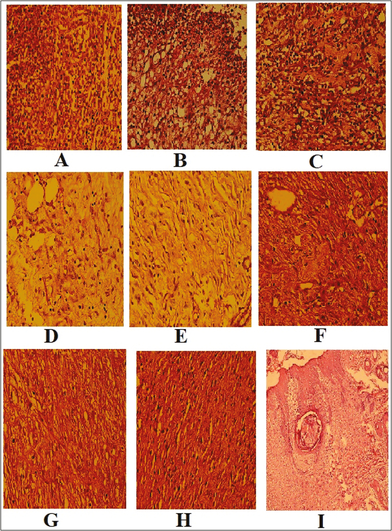 Histomorphologic findings. The fibrinoleukocytes exudate, angiogenesis, and fibroblastic proliferation in a bed of ulcers in control (A), sham (B), fulvic +acid-humic acid (C) on the 7th day, control (D), sham (E), fulvic acid + humic acid (F), on the 14th day, control (G), sham (H), and the fulvic acid +humic acid (I) groups at 21 days postwounding. (Hematoxylin and eosin staining, ×400)