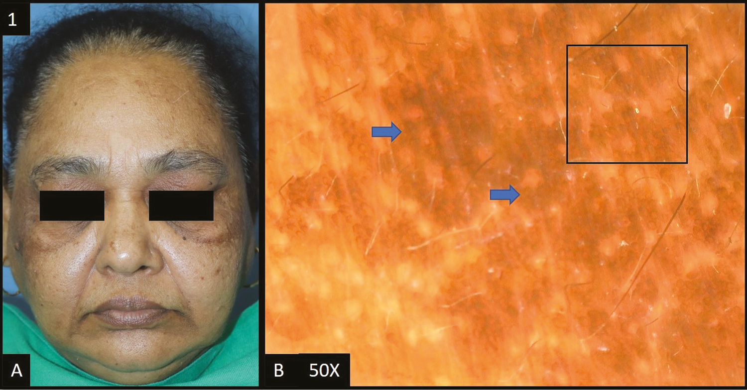 (A) Epidermal melasma—multiple brown to dark brown hyperpigmented patches over bilateral malar and temple area of the face. (B) Dermoscopy (50×) shows accentuated pseudopigment network with perifollicular and perieccrine sparing (black square). Brown to dark brown dots and globules deposited in the pseudoreticular network (blue arrows)