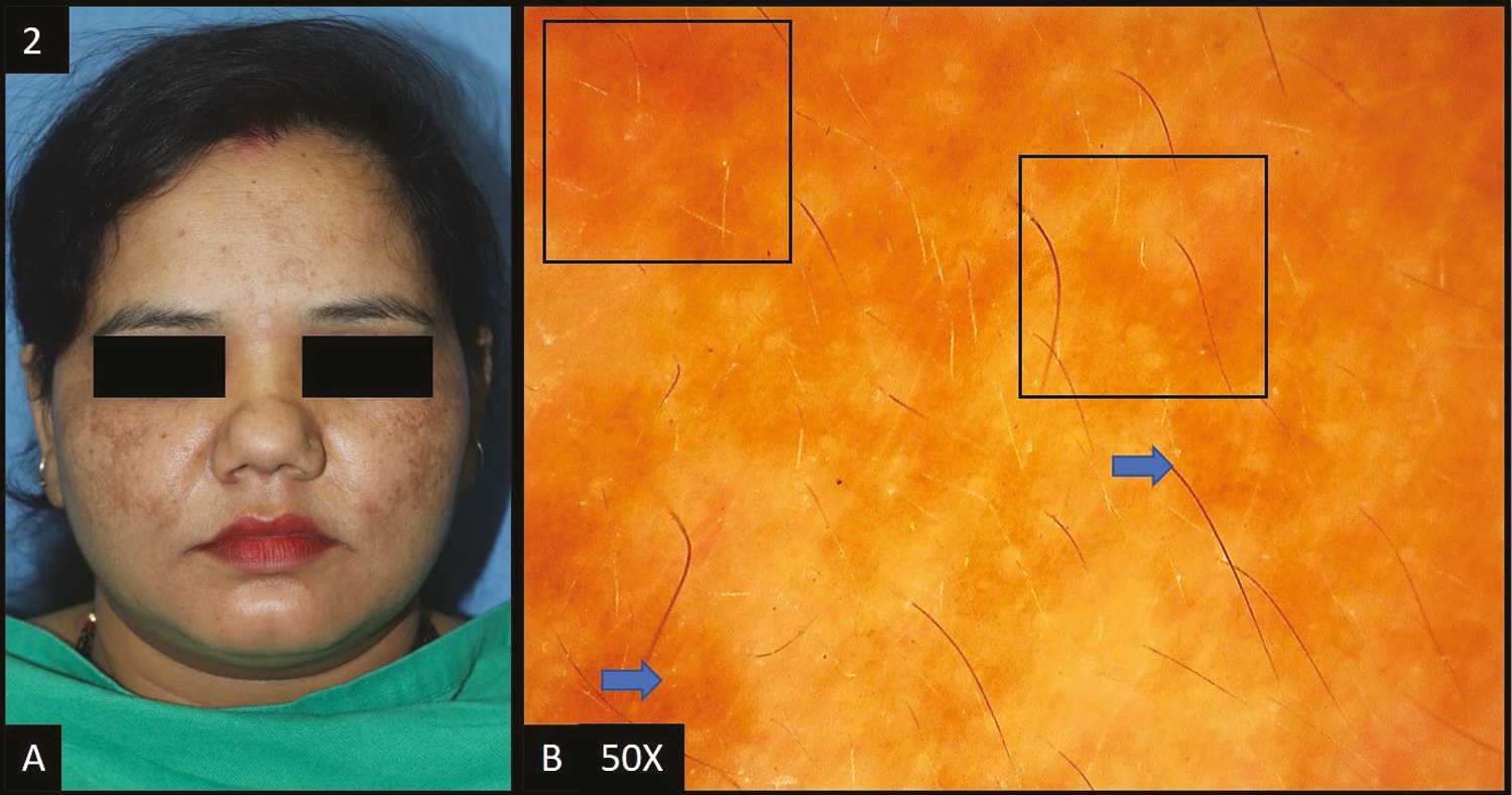 (A) Dermal melasma—multiple light brown hyperpigmented patches over bilateral malar area of the face. (B) Dermoscopy (50×) shows accentuated pseudopigment network with light brown colored dots and globules (blue arrows) and background erythema (dark blue squares)