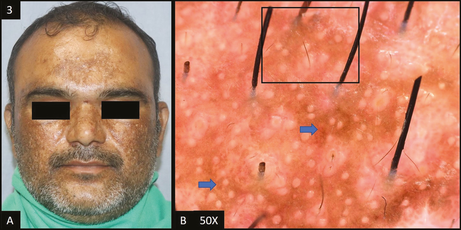 (A) Mixed melasma—multiple brown to dark brown, hyperpigmented patches over bilateral cheeks, nose and forehead. (B) Dermoscopy (50×) shows accentuated pseudopigment network (black square) with light brown to brown colored dots and globules (blue arrows) deposited in the network