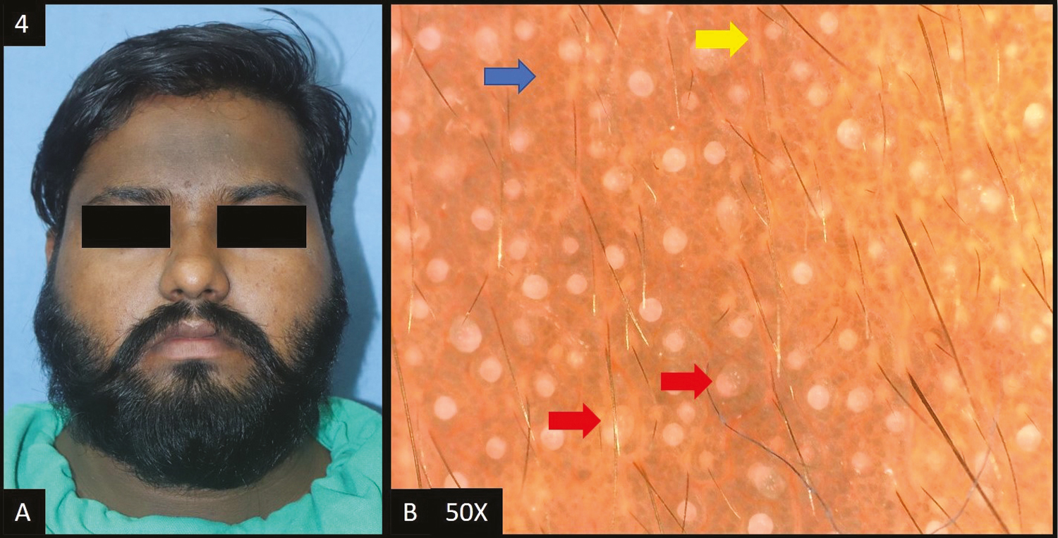 (A) Facial acanthosis nigricans—diffuse dark brown hyperpigmentation over forehead extending to temple area of the face. (B) Dermoscopy (50×) shows presence of crista sulci (yellow arrow) and crista gyri (blue arrow) with brown to dark brown colored dots and globules deposited in the network and dilated follicular openings (red arrows)