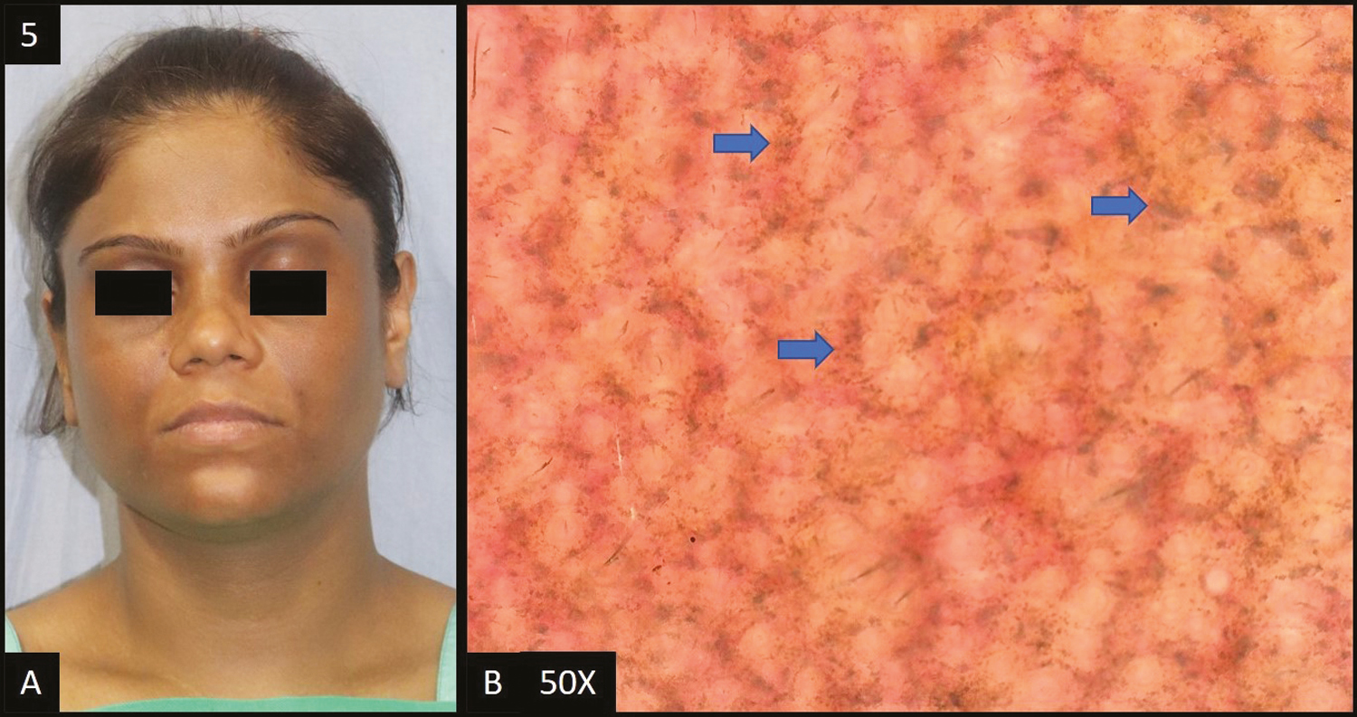 (A) Lichen planus pigmentosus—diffuse slate grey hyperpigmentation over entire face and neck. (B) Dermoscopy (50×) shows accentuated pseudopigment network with slate grey dots deposited in the network giving a diffuse “hem-like” pattern (blue arrows)