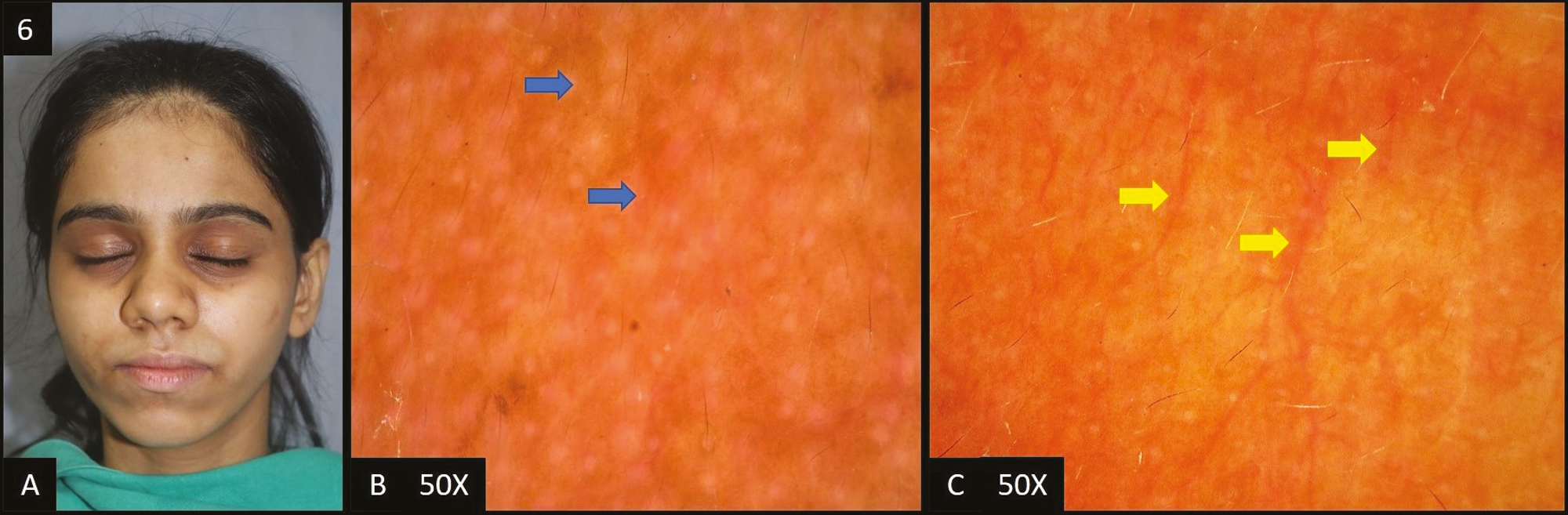 (A) Periorbital hyperpigmentation—hyperpigmentation present in the periorbital area. (B) Pigmented type—dermoscopy (50×) shows brown colored dots and globules in the accentuated pseudopigment network (blue arrows). (C) Vascular type—dermoscopy (50×) shows diffuse vascular network (yellow arrows)