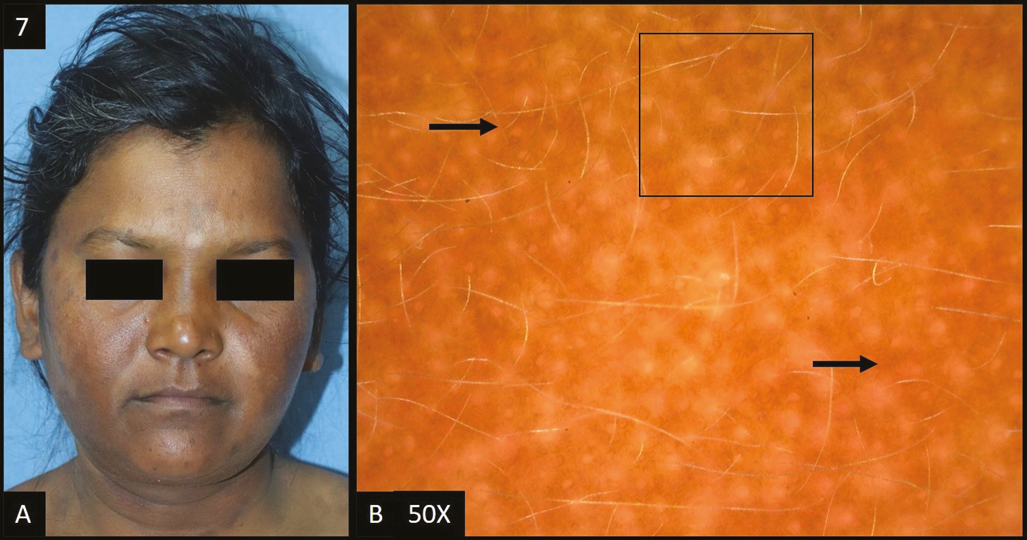 (A) Post-inflammatory hyperpigmentation—multiple, well defined, brown to dark brown colored, hyperpigmented patches over both the cheeks and neck. (B) Dermoscopy (50×) shows brown to dark brown dots and globules (black arrows) deposited in an accentuated pseudopigment network with perifollicular and perieccrine sparing (black square)