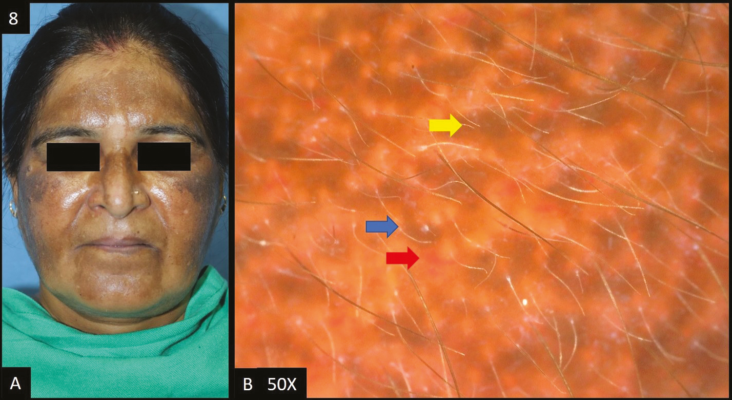 (A) Exogenous ochronosis—multiple dark brown to black-brown hyperpigmented patches over bilateral malar area, forehead and nose. (B) Dermoscopy shows (50×) accentuated pseudopigment network, dark brown to slate grey dots and globules, telangiectasia (red arrow), worm-like pattern (blue arrow) and pigment obliterating follicular openings (yellow arrow)