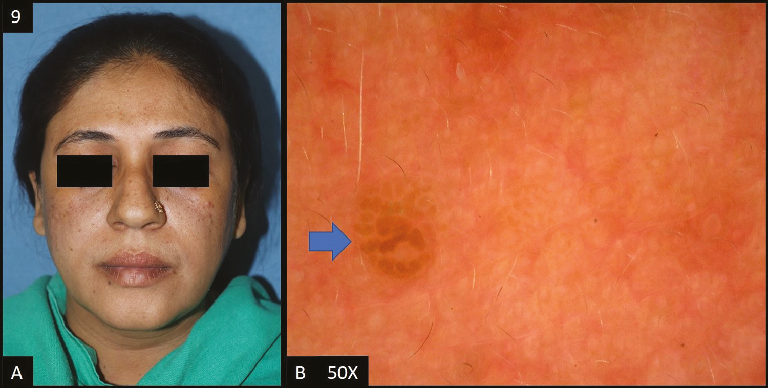 (A) Lentigines—multiple brown colored macules over malar area, forehead and nose. (B) Dermoscopy (50×) shows brown to dark brown colored globules (blue arrow) with perieccrine sparing, focally