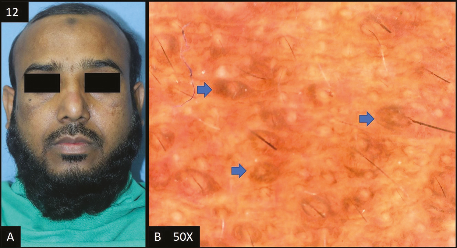 (A) Frictional melanosis—multiple brown to dark brown hyperpigmented patches over forehead and cheeks. (B) Dermoscopy (50×) shows brown to dark brown dots (blue arrow) deposited in perifollicular area with accentuated pseudopigment network