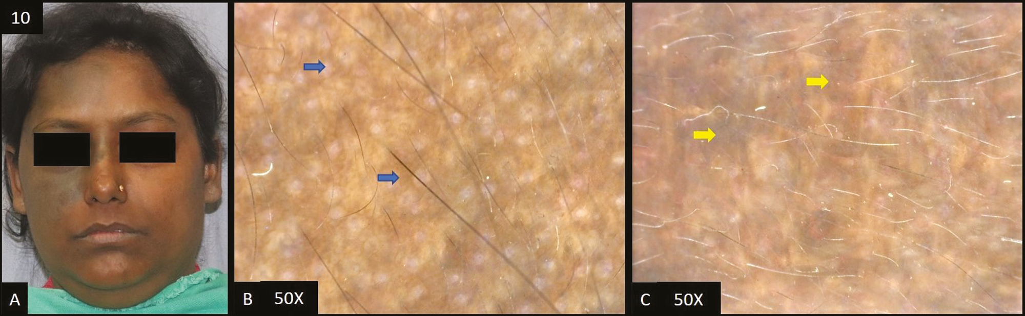 (A) Nevus of Ota—single, well-defined slate grey colored hyperpigmented patch over right forehead, extending to right temple area, periorbital area, and right cheek. (B, C) Dermoscopy (50×) shows slate grey dots/globules, worm-like pattern (blue arrow) and dark brown to grey structureless areas (yellow areas)