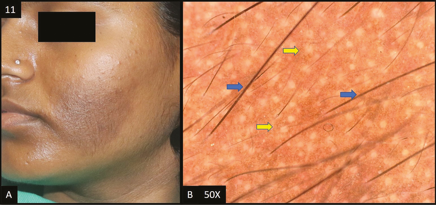 (A) Becker’s nevus—single, well defined, hyperpigmented tan to brown patch with hypertrichosis. (B) Dermoscopy (50×) shows accentuated pseudopigment network with brown colored dots and globules (yellow arrows). It also shows increase number of terminal (blue arrows) and vellus hairs