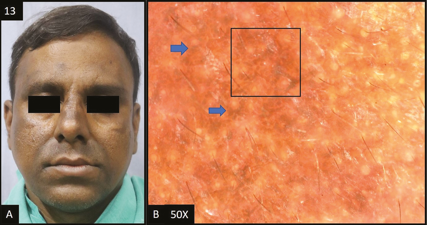 (A) Olanzapine-induced hyperpigmentation—multiple dark brown hyperpigmented patches over forehead, nose, perioral and temple area of the face. (B) Dermoscopy (50×) shows brown to dark brown dots and globules (blue arrows) deposited in the accentuated pseudopigment network (black square)