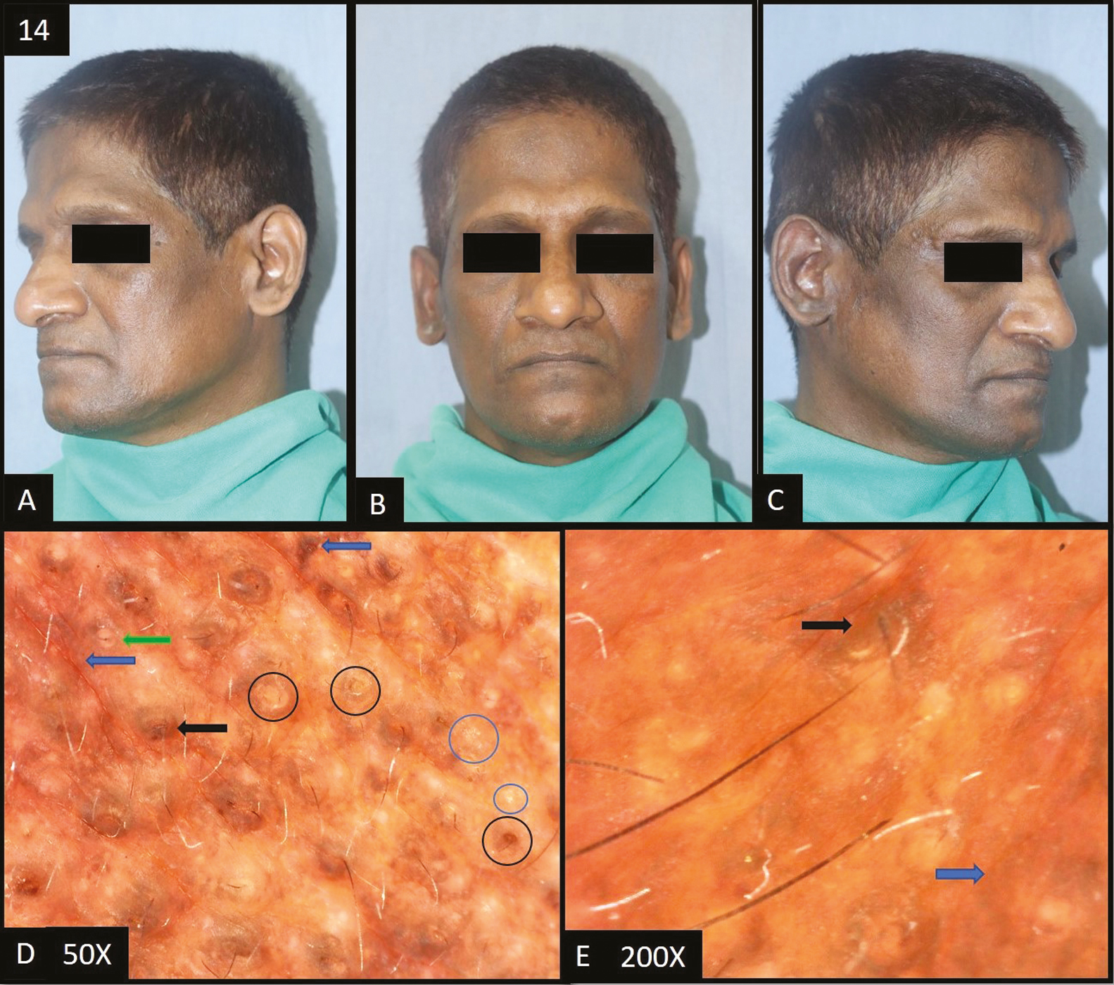 (A–C) Riehl’s melanosis—Diffuse dark brown to slate grey hyperpigmentation over the face more prominent on the lateral rather than the central area of the face. [D (50×), E (200×)] Dermoscopy shows dark brown to slate grey dots (blue arrow) deposited in the perifollicular area, perifollicular whitish halo (green arrow), pigment obliterating follicular openings (black arrow), follicular keratotic plugs (black circle) and slight scaling (blue circle)