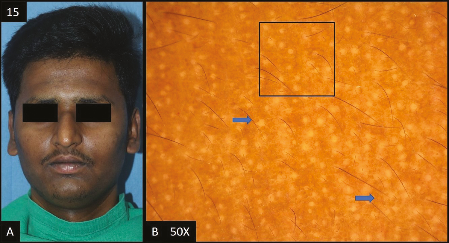 (A) Tanning—diffuse, ill defined, dark brown hyperpigmentation over forehead extending to temple area of face. (B) Dermoscopy (50×) shows accentuated pseudopigment network (black square) with brown to dark brown dots and globules (blue arrows) deposited in the network