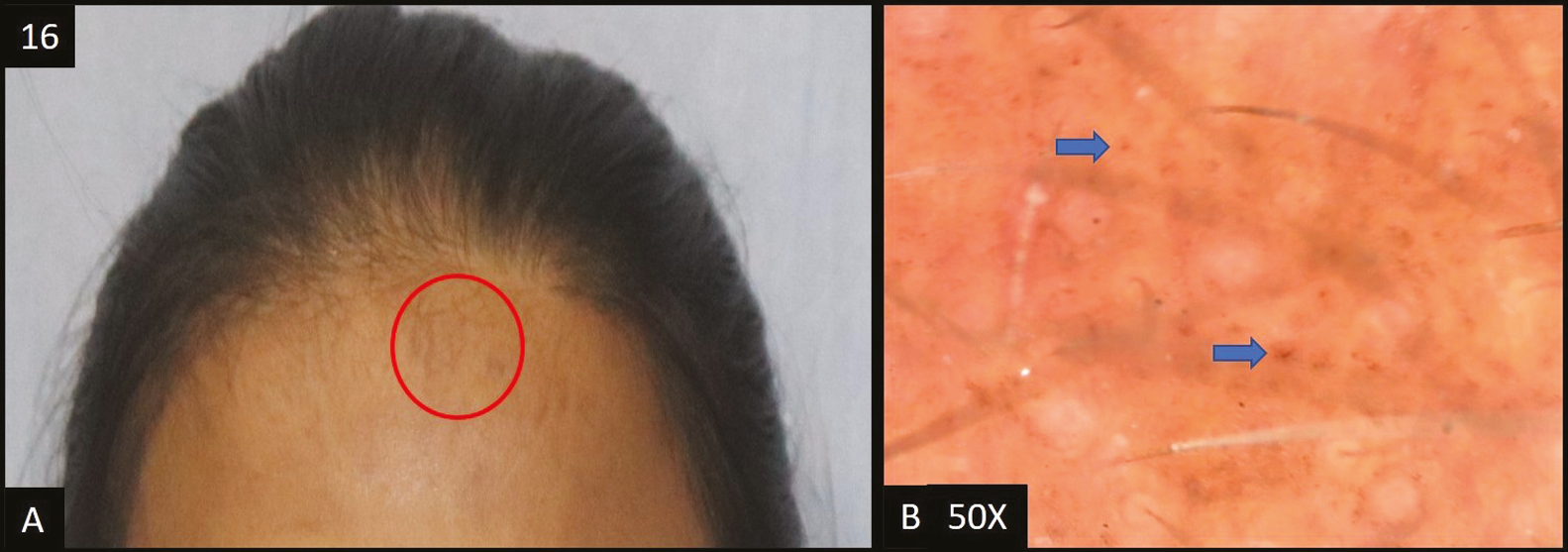 (A) Macular amyloidosis—multiple hyperpigmented patches over forehead, shoulders and neck. (B) Dermoscopy (50×) multiple scattered brown dots (blue arrow) in the pseudopigment network