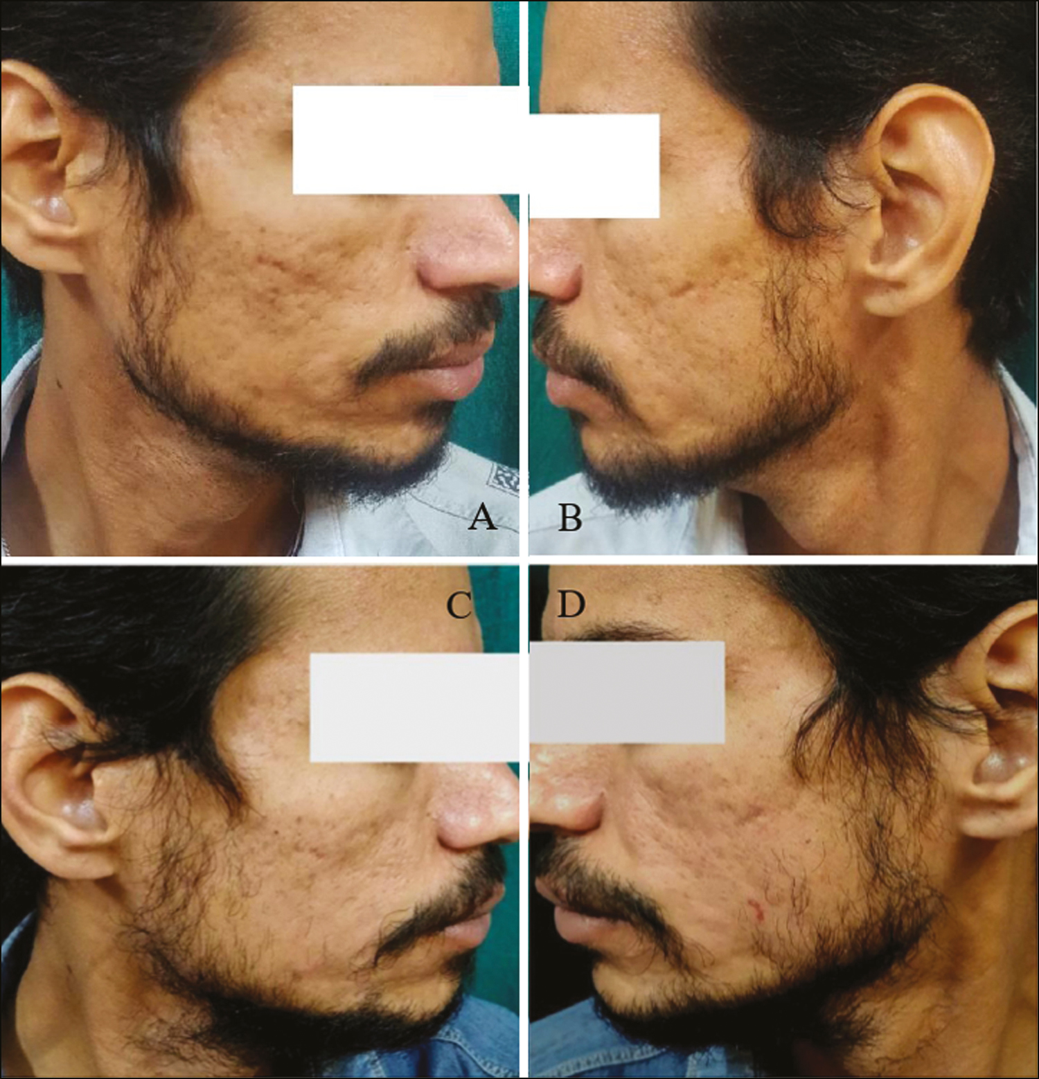 (A and B) Pretreatment photographs of the patient with acne scars. (C and D) Posttreatment photographs 1 month after three sessions of subcision followed by microneedling