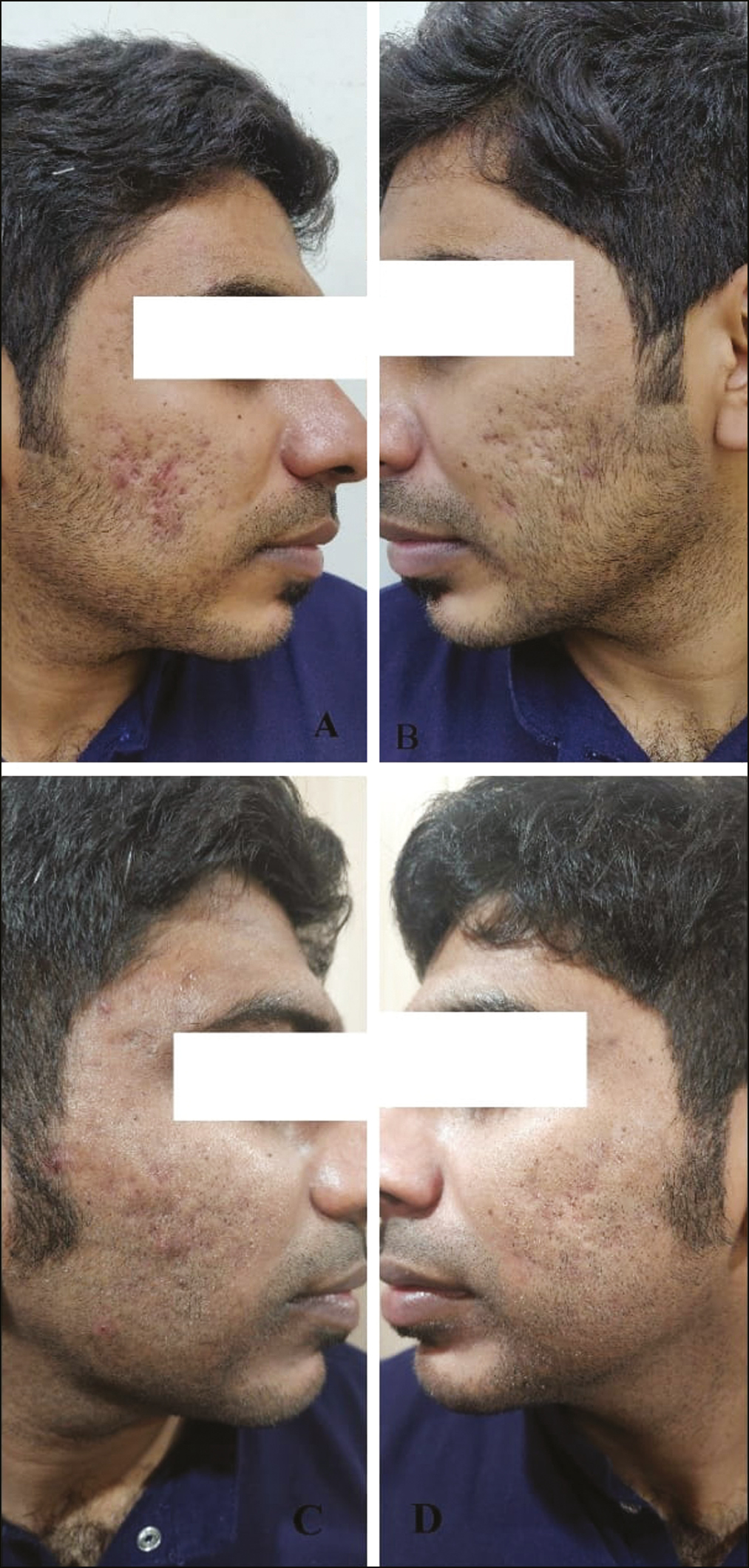 (A and B) Pretreatment photographs of atrophic acne scars. (C and D) Posttreatment photograph after three sessions of subcision and microneedling