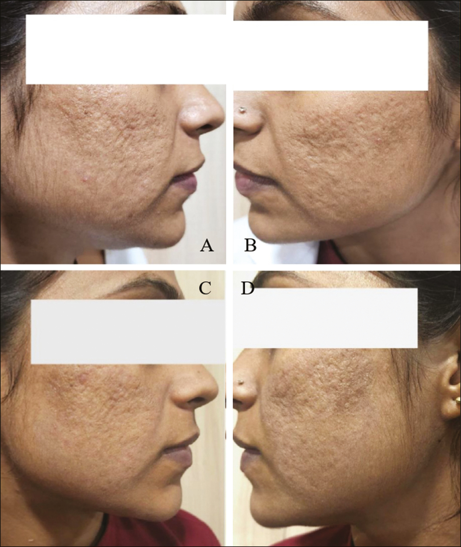 (A and B) Pretreatment photographs of the patient with acne scars. (C and D) Posttreatment photographs 1 month after three sessions of subcision followed by microneedling and topical PRP