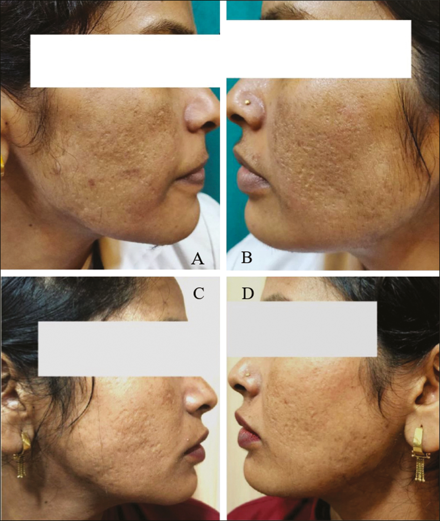 (A and B) Pretreatment photographs of the patient with acne scars. (C and D) Posttreatment photographs 1 month after three sessions of subcision followed by microneedling and topical PRP