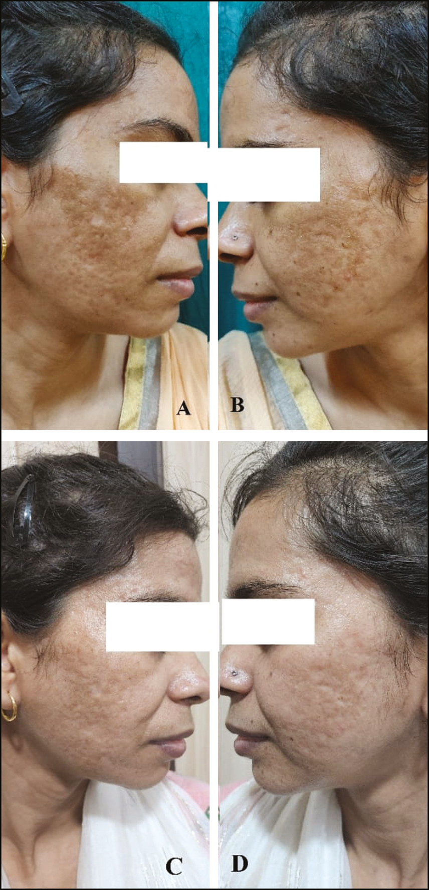 (A and B) Pretreatment photographs of the patient with acne scars. (C and D) Posttreatment photographs 1 month after three sessions of subcision followed by microneedling and topical PRP shows reduction in scar grading along with significant reduction in pigmentation