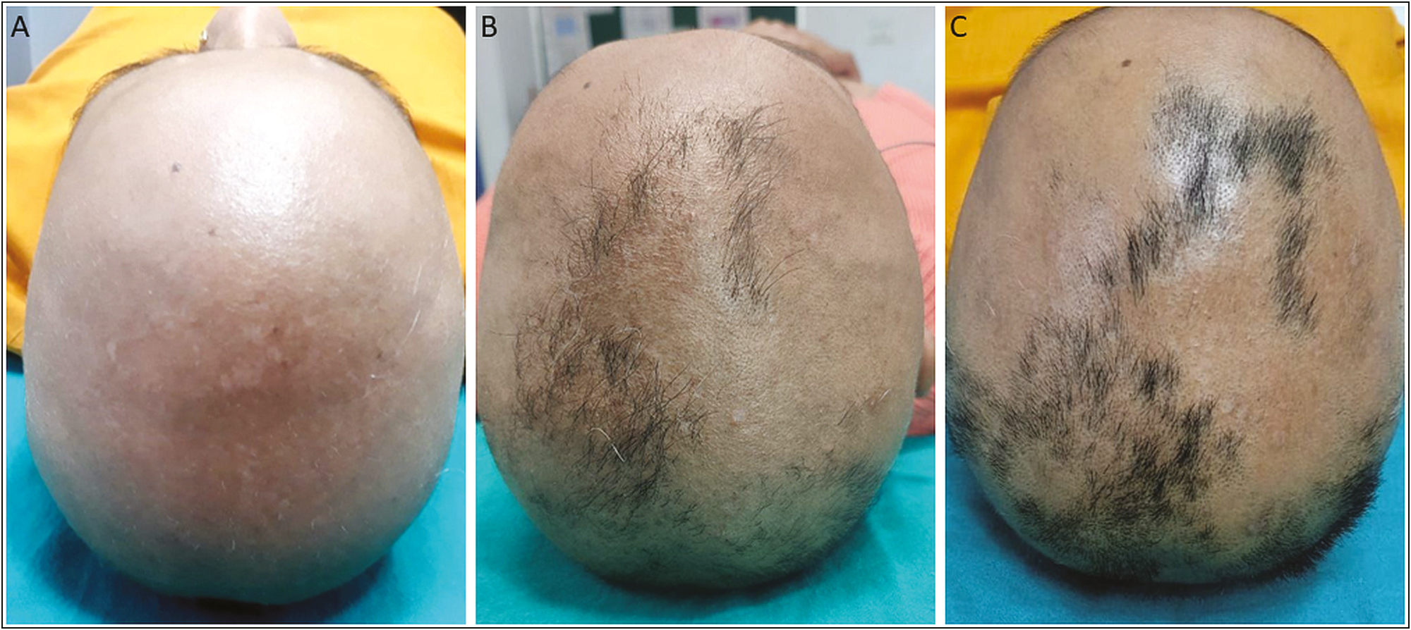 A: Total hair loss over scalp. B: Hair growth after first session of modified PRP. C: Hair growth after fourth session of modified PRP